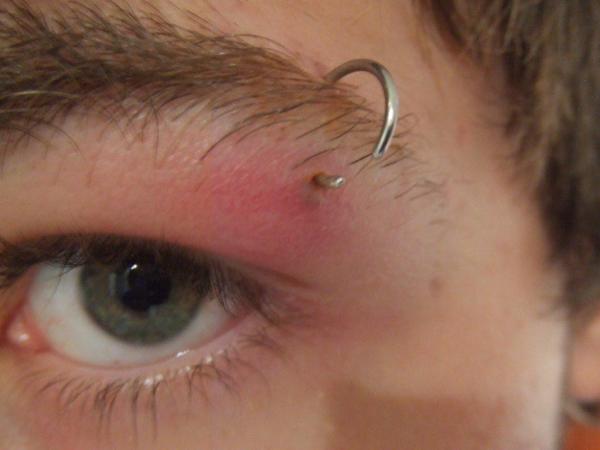 &iquest;Qu&eacute; hacer con un piercing infectado?