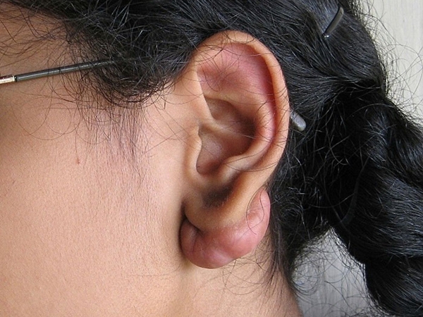 &iquest;C&oacute;mo evitar los queloides en las orejas?