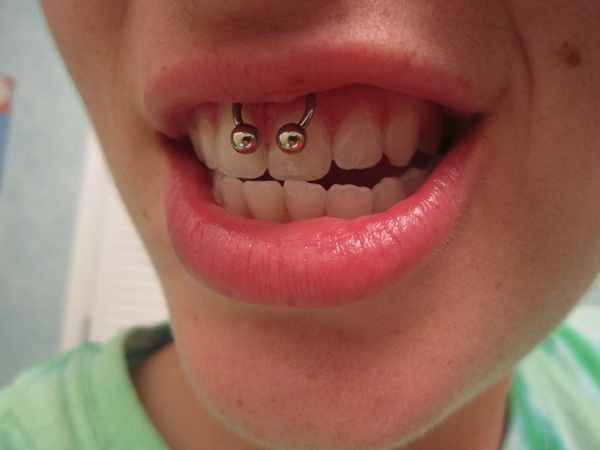 Consejos para hacerse un piercing en el frenillo de la enc&iacute;a
