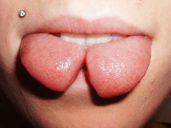 Riesgo del procedimiento para la lengua b&iacute;fida