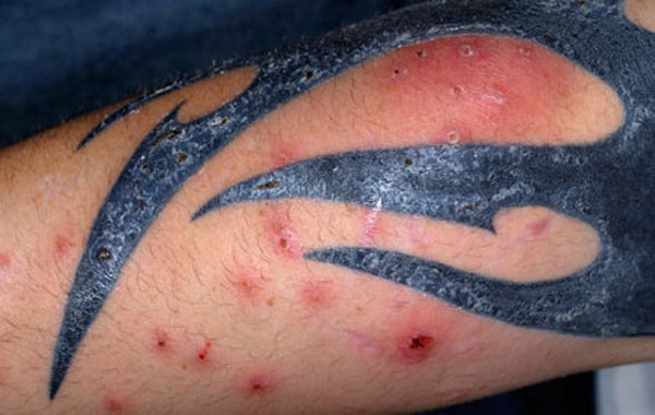 Los riesgos de hacerte un tatuaje