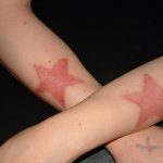 Tatuajes con técnica branding. (tatuajex.com) Todos los derechos reservados.